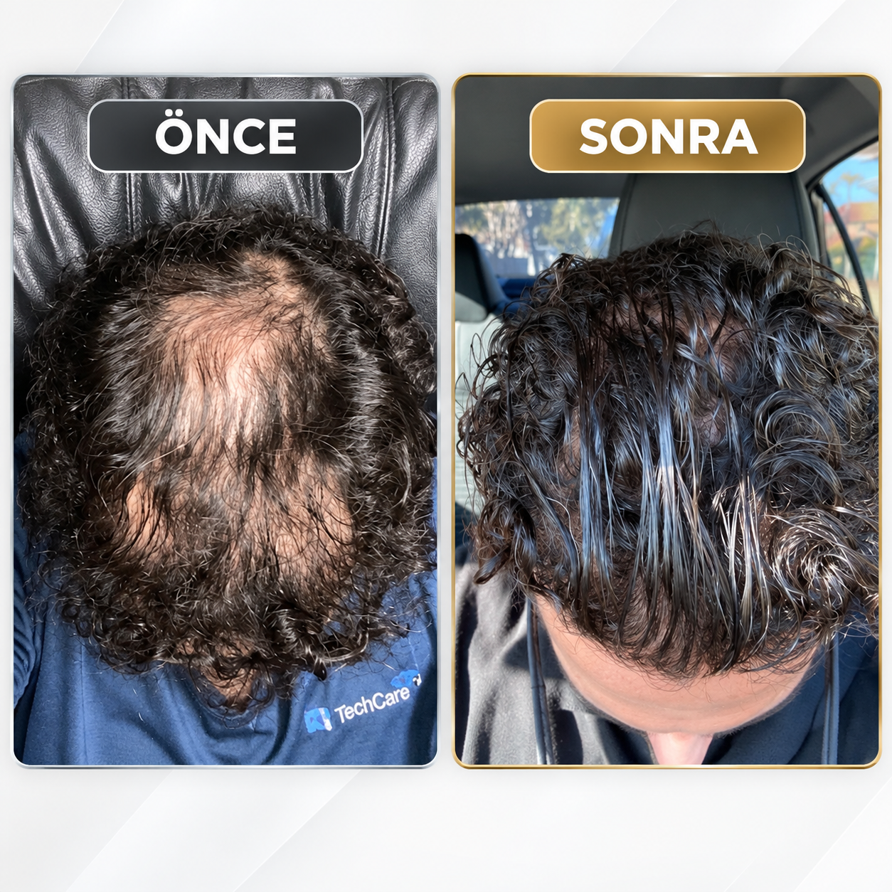 Tepe bölgesindeki saç görünümünü önce ve sonra karşılaştıran fotoğraf