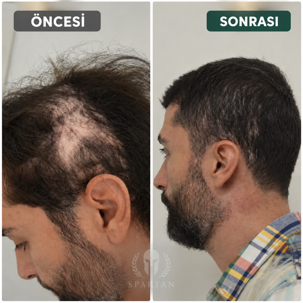 Erkek kullanıcının saç görünümünü yandan önce ve sonra karşılaştıran fotoğraf