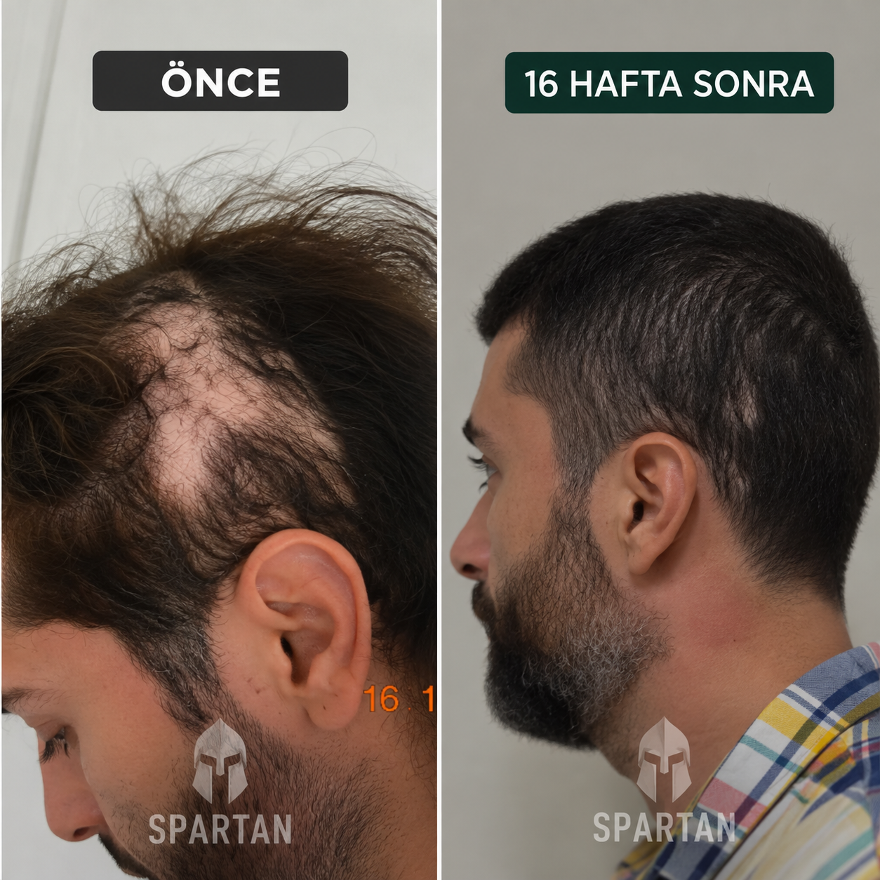 Erkek kullanıcının saç görünümünü 16 hafta arayla karşılaştıran fotoğraf